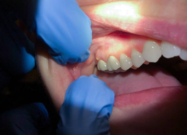 Best Emergency Wisdom Teeth Removal in Warrensburg, MO